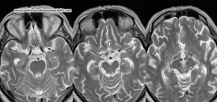 what-is-progressive-supranuclear-palsy-psp-dr-shivam-mittal