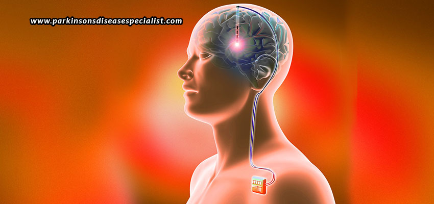 Deep-Brain-Stimulation-The-Cure-To-Parkinson’s-Disease